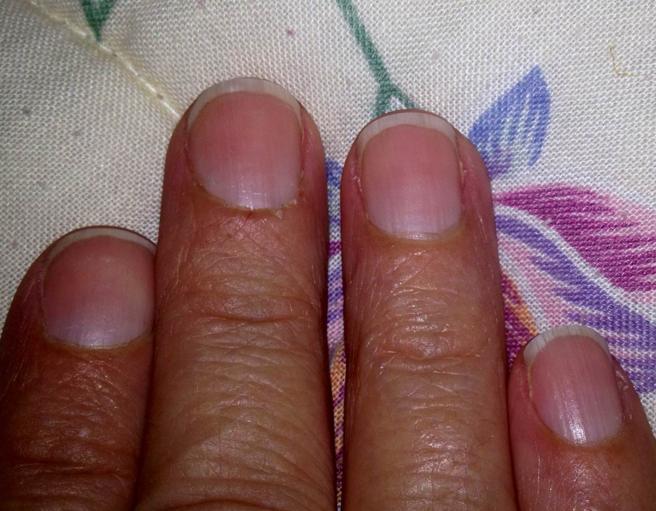 What causes dry cuticles?